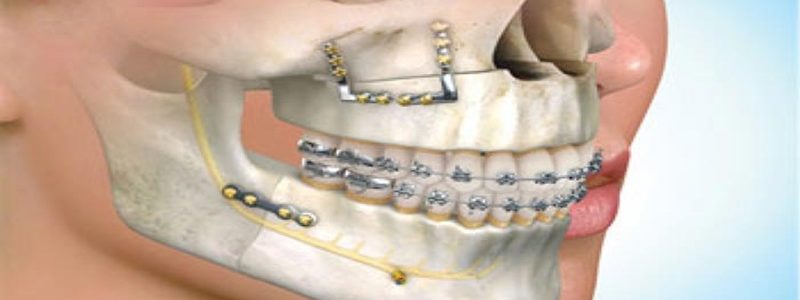 انواع جراحی آرتوگناتیک