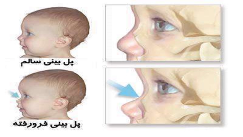 جسر الأنف | جراحة الآنف أصفهان - جراح الفك في أصفهان