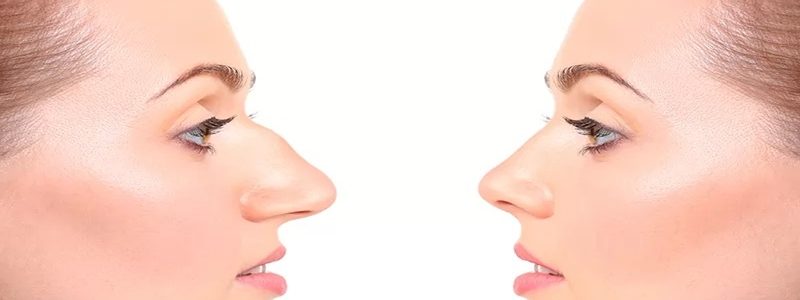 انواع جراحی زیبایی بینی