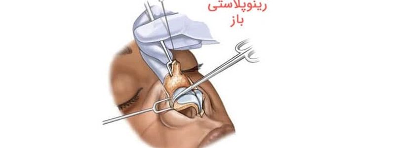 عملية تجميل الأنف المفتوحة مقابل عملية تجميل الأنف المغلقة
