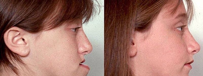 تأثیرات جراحی فک و بینی بر خواب