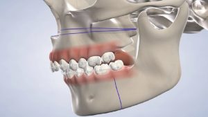 Types of jaw and facial surgery | Isfahan nose surgeon - Jaw surgeon of Isfahan