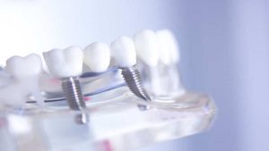 جراح فک اصفهان | درباره تفاوت متخصص ایمپلنت و دندانپزشک بدانید :