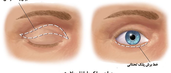 blefaroplastia