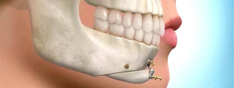 Types of jaw and facial surgery