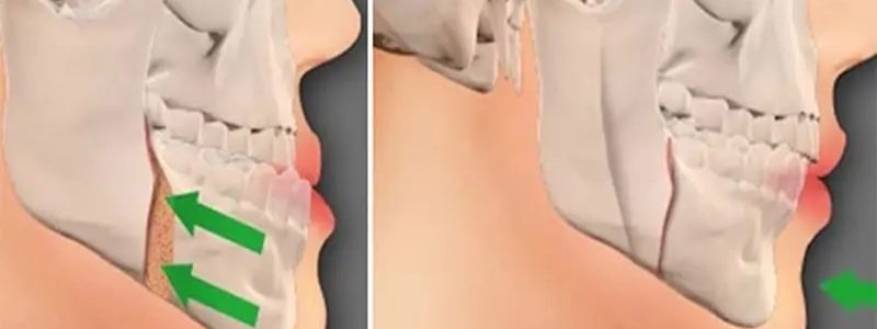 فواید جراحی فک