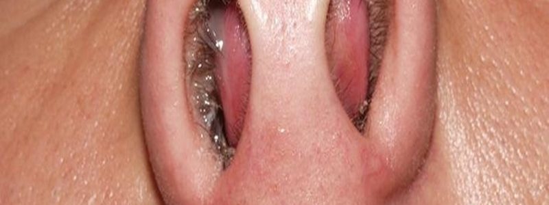 التهاب الجيوب الأنفية بعد جراحة الأنف (التهاب الجيوب الأنفية بعد العملية الجراحية)