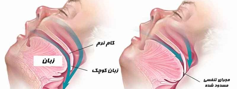 جراحة لتوقف التنفس أثناء النوم
