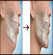 Jaw surgery and how to do it