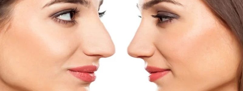 تفاوت‌های بین رینوپلاستی باز و بسته