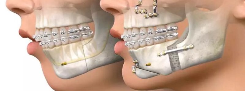 The role of technology in combined nose and jaw surgery