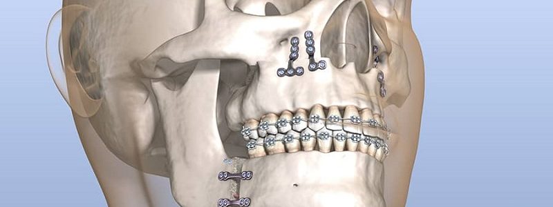 Orthognathic surgery for sleep apnea