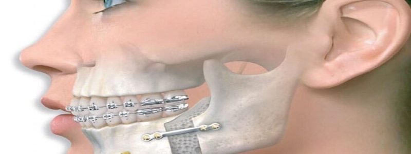جراحی فک و تأثیر آن بر روی گفتار و صدا