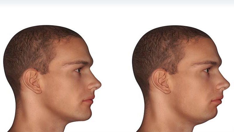 Cosmetic surgery of the lower jaw (Mandible) | Dr Behnam khorami (Isfahan nose surgeon - Jaw surgeon of Isfahan)