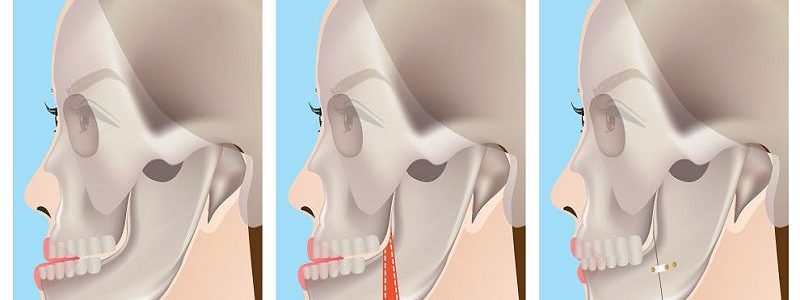 The effect of jaw surgery on the function of facial muscles and expression