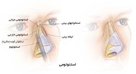 استئوتومی درعمل جراحی بینی چیست؟