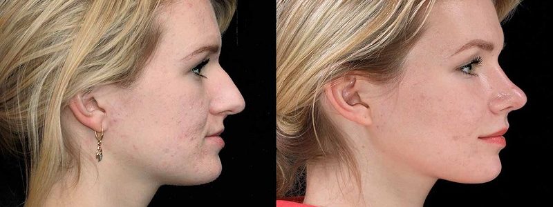 Possible complications of combined nose and jaw surgery