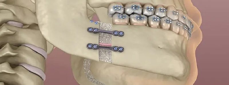 تأثیر داروهای مسکن بر زمان بهبودی بعد از جراحی فک