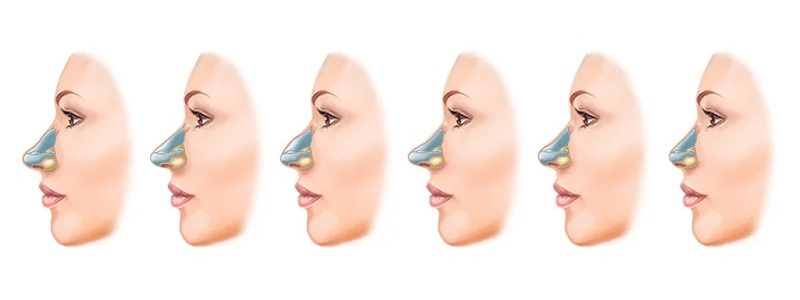 Conditions for nose surgery based on its type