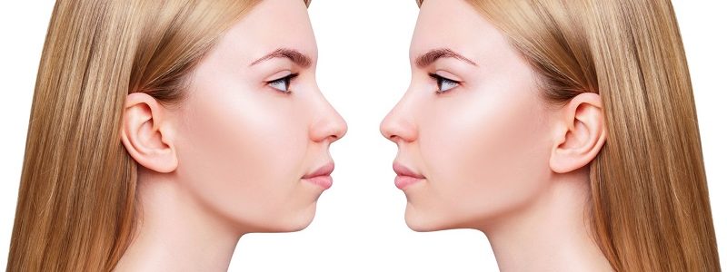 Combined nose and jaw surgery in children and adolescents