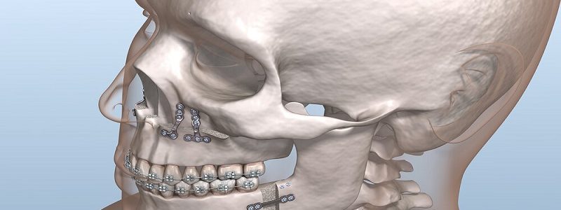 What do you know about jaw orthognathic surgery?