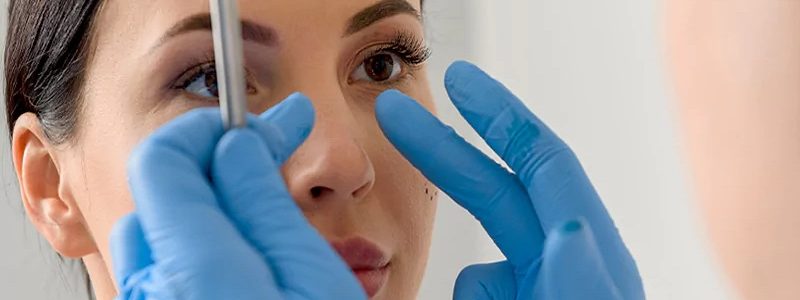 Conditions nécessaires à la rhinoplastie