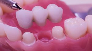 جراح فک اصفهان | بریج دندان باله دار یا مریلند