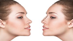 Conditions for nose surgery based on its type | Isfahan nose surgeon - Jaw surgeon of Isfahan