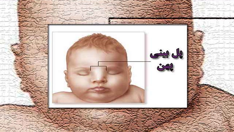 Types of nose bridge | Isfahan nose surgeon - Jaw surgeon of Isfahan