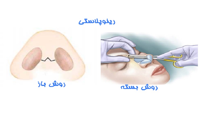 تفاوت جراحی بینی باز و جراحی بینی بسته | جراح بینی اصفهان