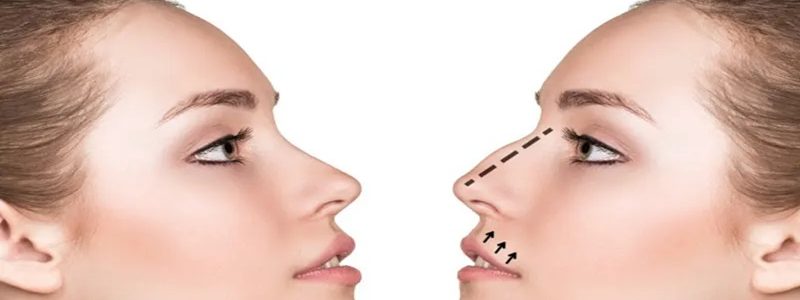 الاختلافات والتشابه في طرق جراحة الأنف