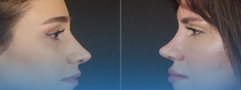 تفاوت‌های فرهنگی در جراحی بینی