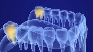 جراح فک اصفهان | تهدید دندان عقل برای دیگر دندان ها