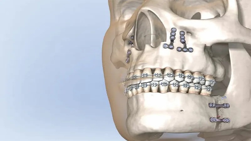 The role of technology in combined nose and jaw surgery | Isfahan nose surgeon - Jaw surgeon of Isfahan | Dr Behnam khorami