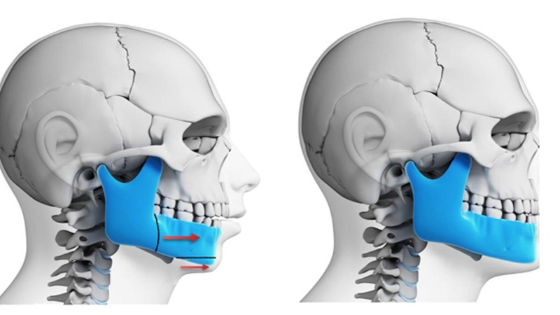 بررسی عوارض جانبی داروهای تجویزی در دوره نقاهت بعد از جراحی فک | جراح بینی اصفهان - جراح فک اصفهان | دکتر بهنام خرمی