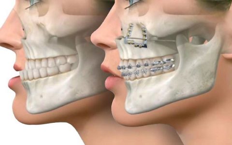 Orthodontie en chirurgie de la mâchoire