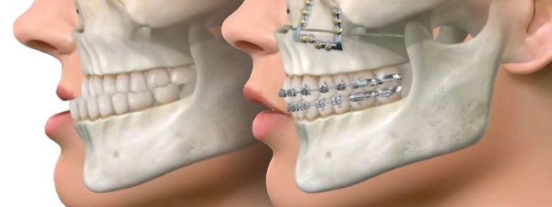 تقويم الأسنان في جراحة الفك