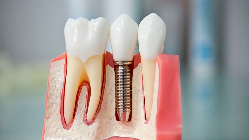 جراح بینی اصفهان  | موفقیت کاشت ایمپلنت دندان